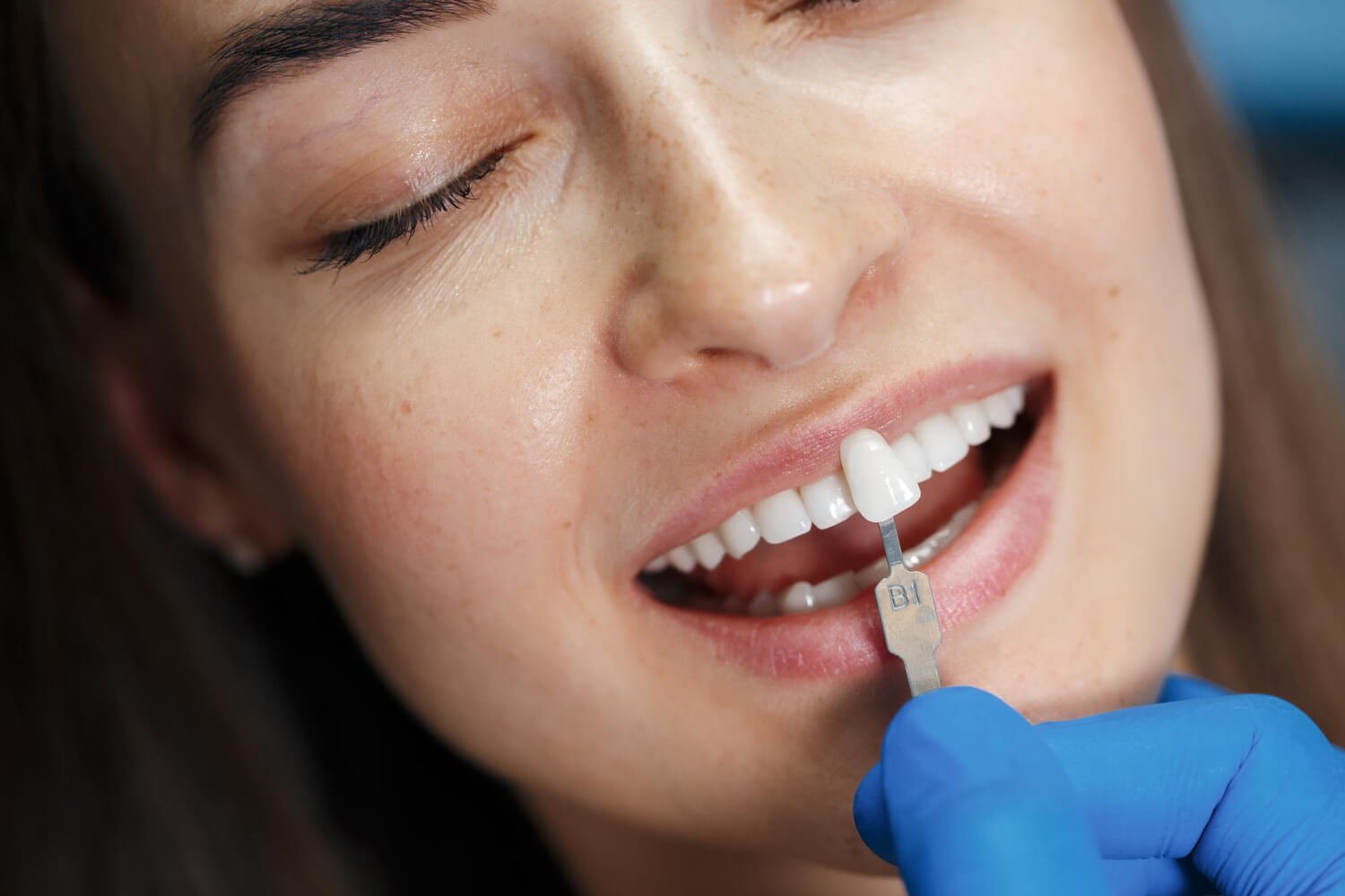 Lente de Contato Dental ou Faceta? Entenda a Diferença