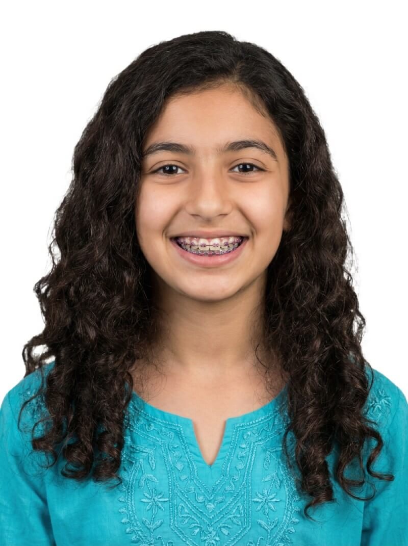 Jovem utilizando aparelho estético ortodontia fixa