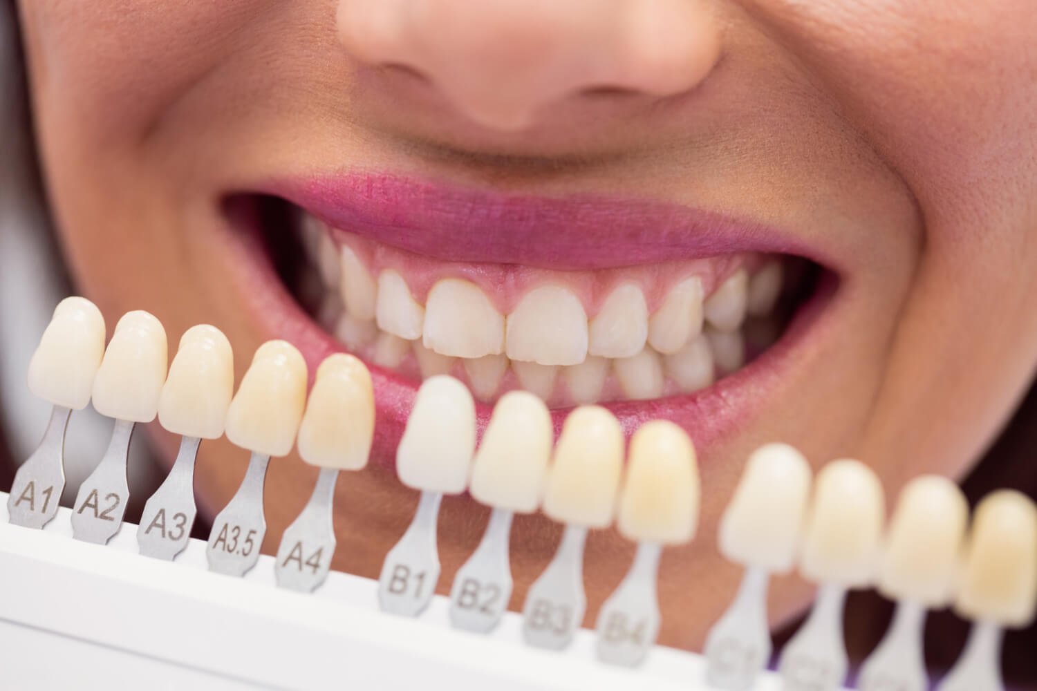 Close de sorriso feminino com escala de cores para escolha de tons de lentes de contato dental na Pleno Ser em São Bernardo do Campo.
