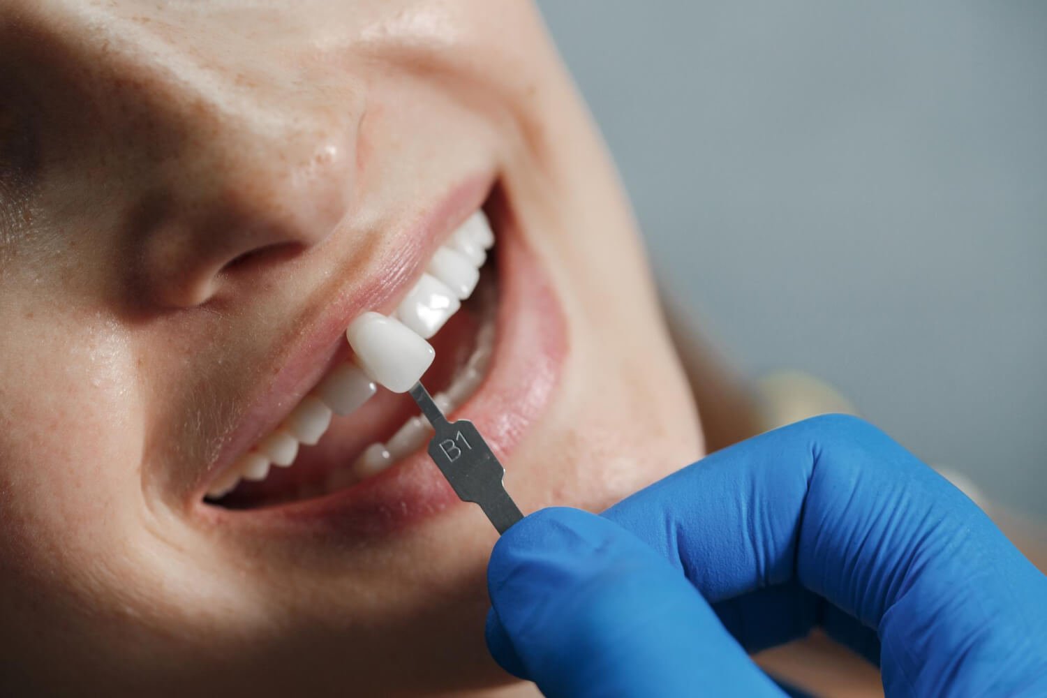 Dentista com luva azul usa escala de cor B1 para planejar lentes de contato dental na Clínica Pleno Ser em São Bernardo do Campo.